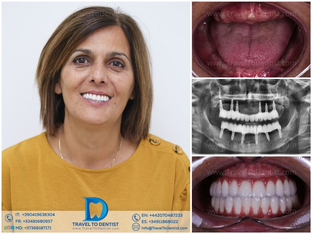 Caso clínico 5 - blanqueamiento dental avanzado